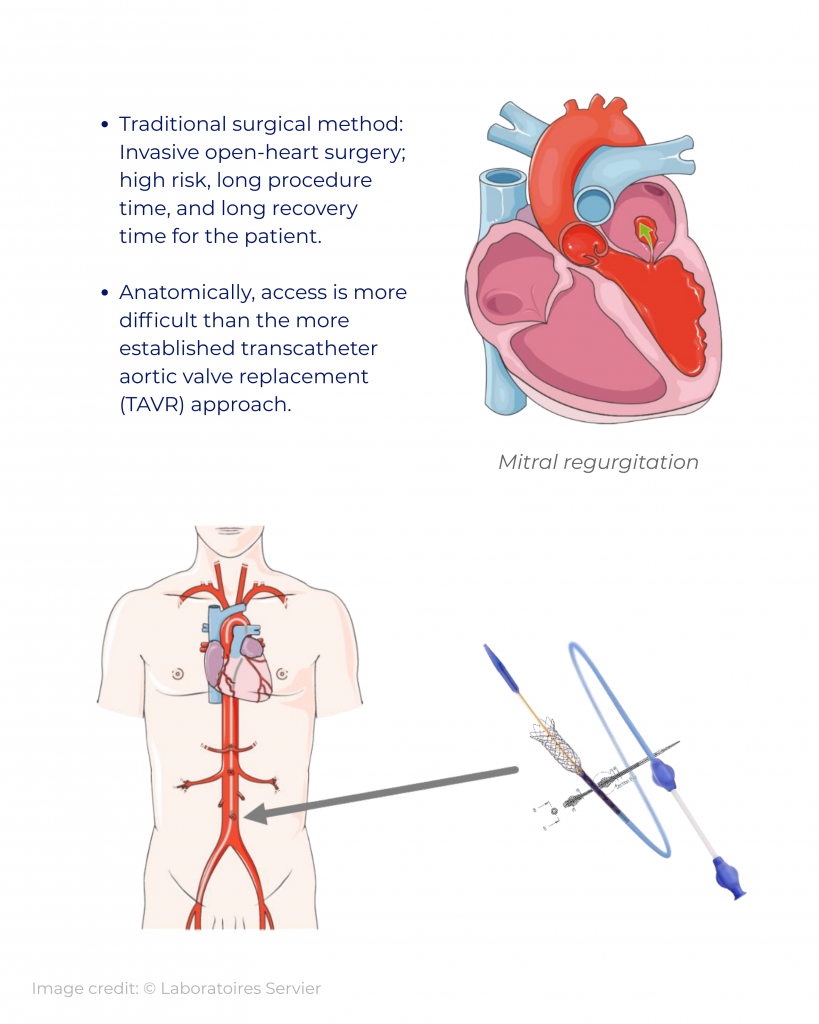 ▪ traditional surgical method invasive open heart surgery; high risk, long procedure time, and long recovery time for the patient. ▪ anatomically, access is more difficult than the more establishe (2)