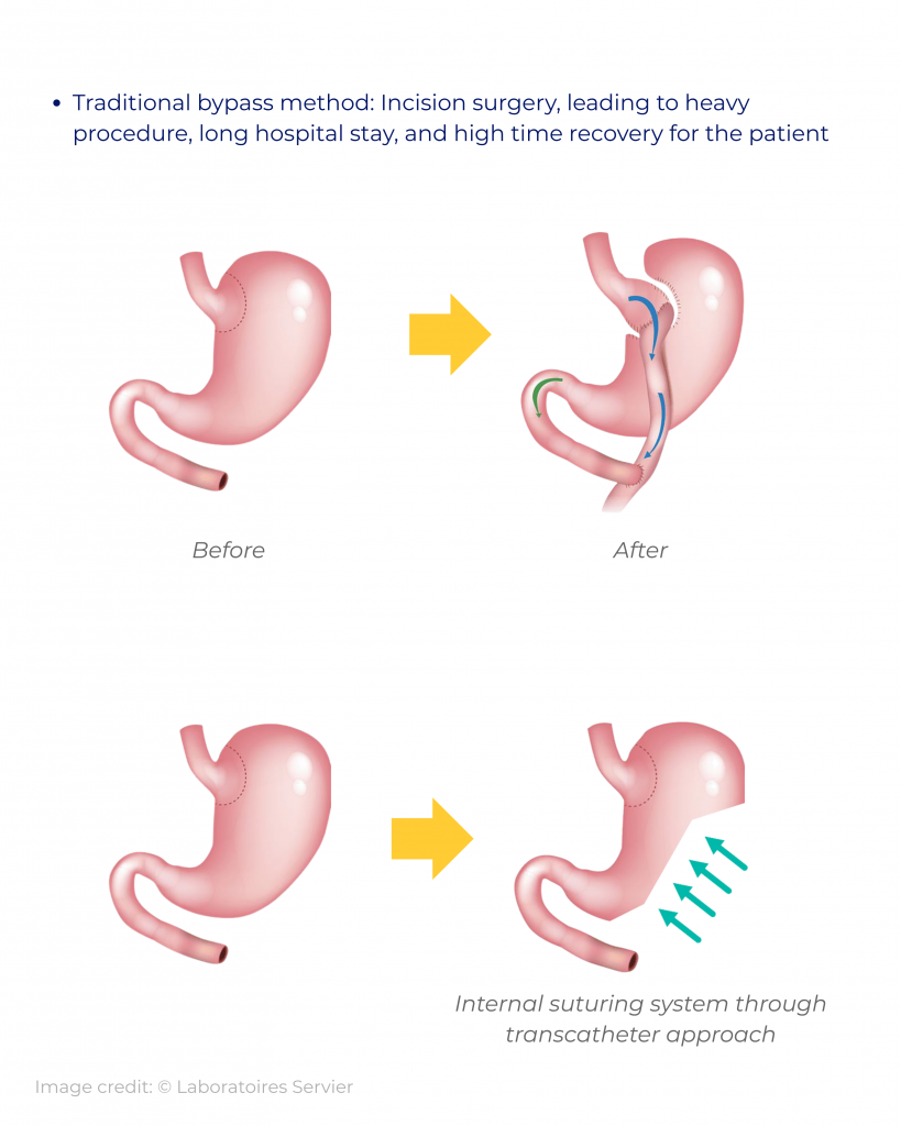 ▪ traditional surgical method invasive open heart surgery; high risk, long procedure time, and long recovery time for the patient. ▪ anatomically, access is more difficult than the more establishe (3)