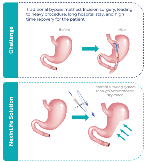 Use case: bariatric delivery system